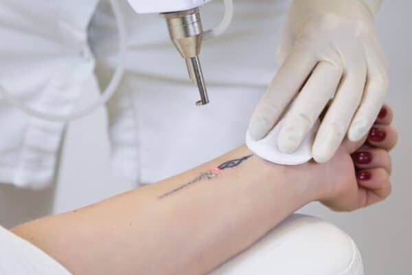 Home - Findingneverlandthemusical 37 laser tattoo removal laser tattoo removal 8